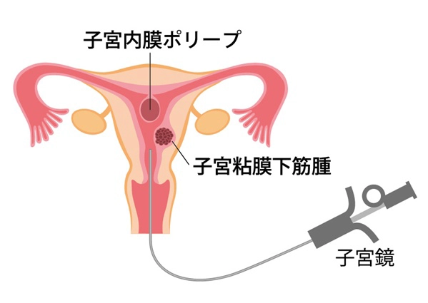 子宮鏡検査