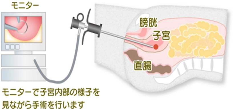 子宮鏡検査